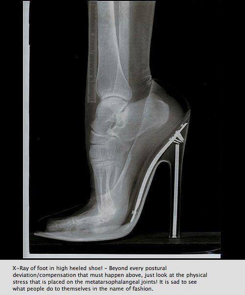 X-Ray of foot in high heeled shoe